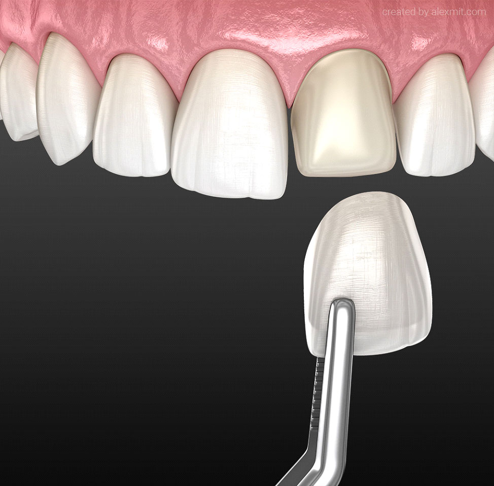 Dental Veneer installation procedure over central incisor. 3D illustration