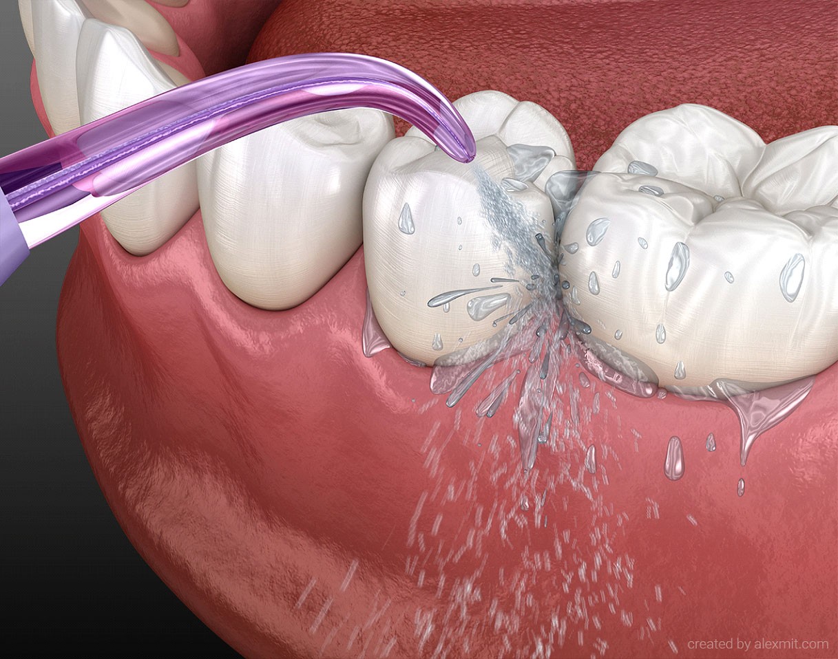 Irrigator, Water teeth cleaning. Medically accurate 3D illustration of oral hygiene.